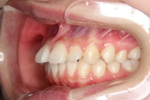 過蓋咬合にて上顎中切歯が突き上げられています